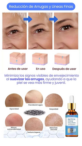 BOTOX SOLUTION